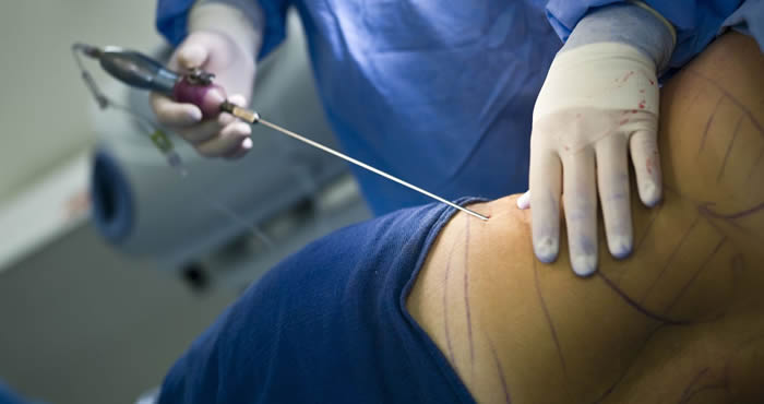 Liposuction: Vücut Şeklini Düzelten Cerrahi Bir Seçenek