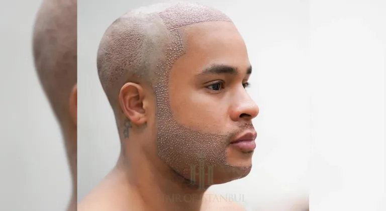 Hair Transplant Turkey