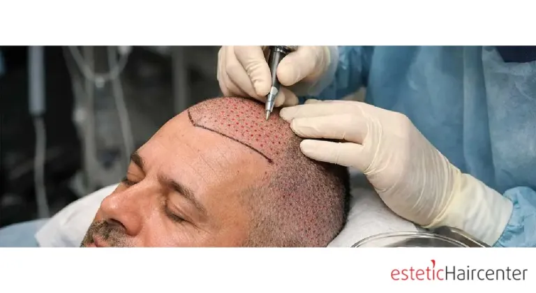 Saç Ekimi ile Sağlıklı Bir Dönüşüm Mümkün mü?