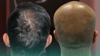 Kaliteli ve Güvenilir Saç Ekim İçin Doğru Adres: Este Surgery